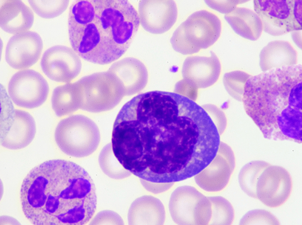 Unileão abre inscrições para turma de Especialização em Hematologia Clínica